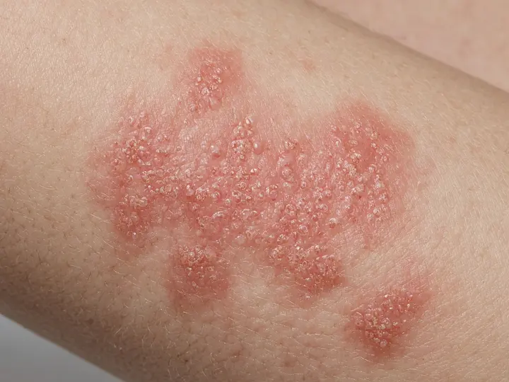 Imagem ilustrativa de pele inflamada no padrão discutido na dermatite de contato.