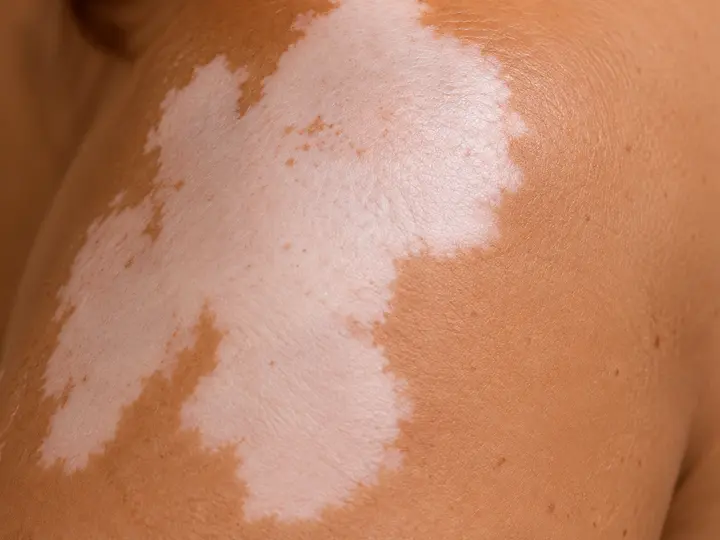 Imagem ilustrativa de área da pele com perda de cor, no padrão discutido no vitiligo.
