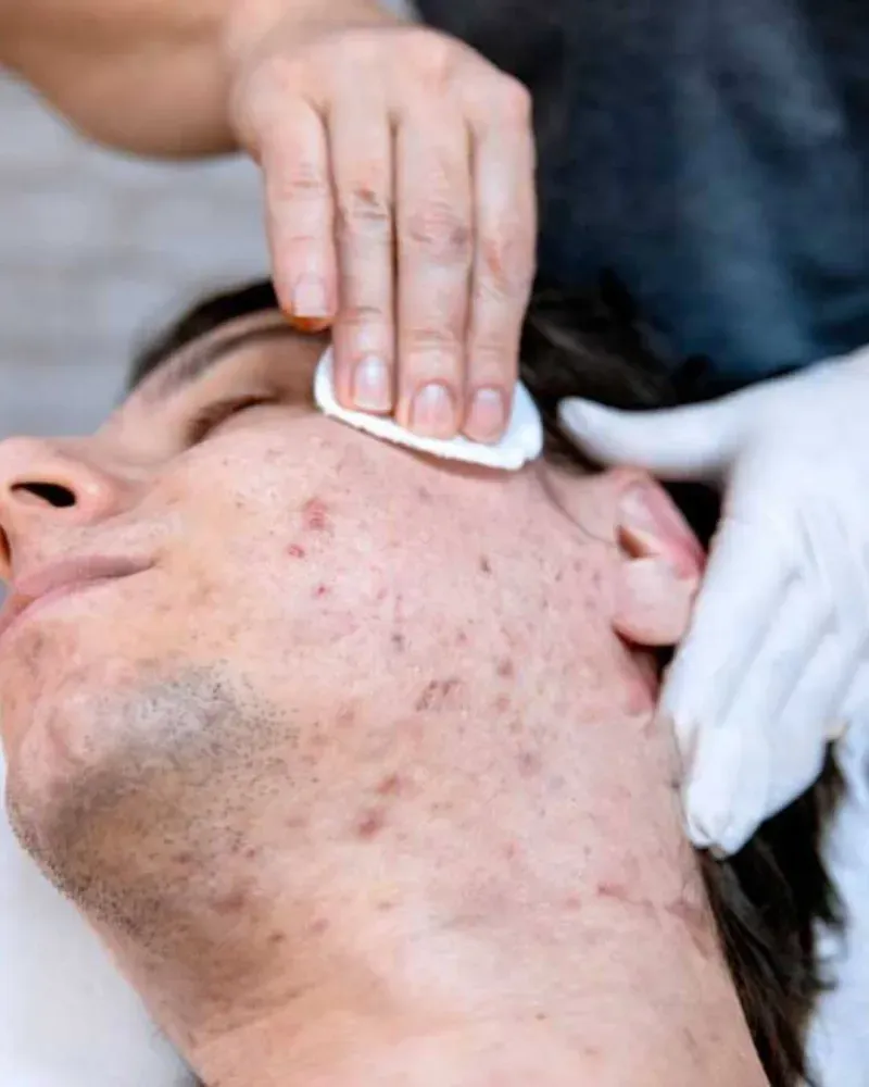 Tratamento de acnes e espinhas no Instituto Venanzi, Campo Mourão