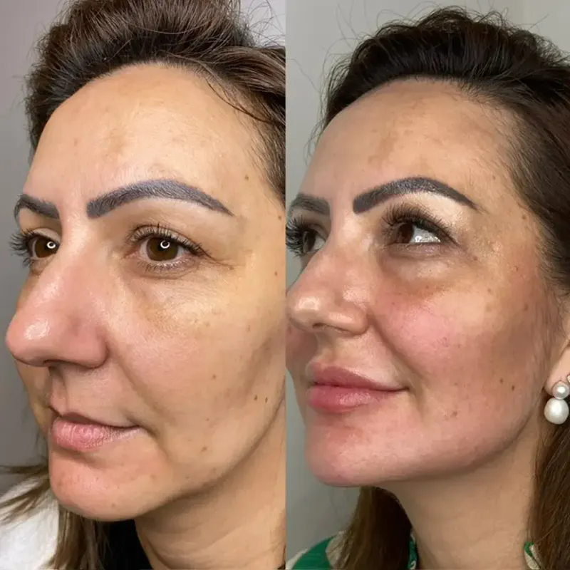 Bichectomia para harmonização facial no Instituto Venanzi, Campo Mourão