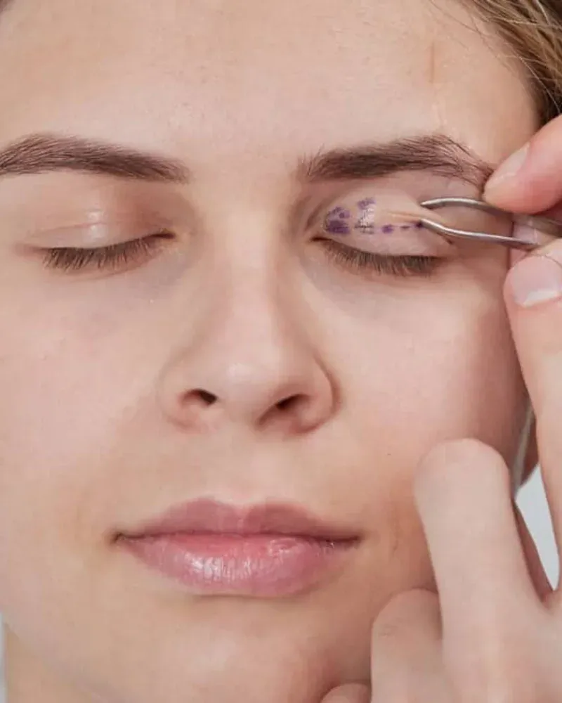 Blefaroplastia em Campo Mourão no Instituto Venanzi