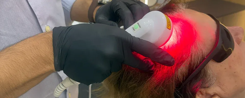 Laser capilar no couro cabeludo durante tratamento no Instituto Venanzi, Campo Mourão