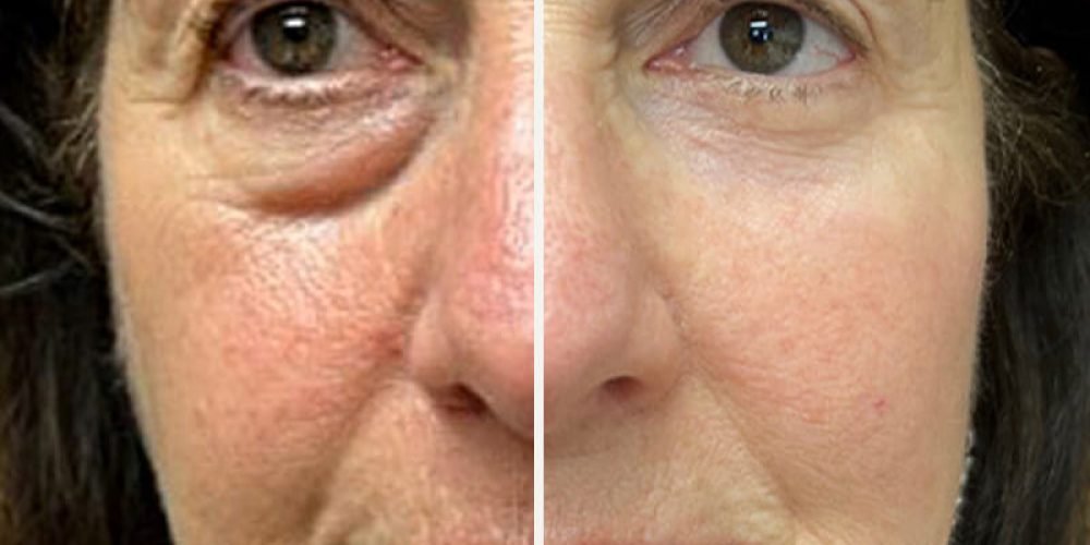 blefaroplastia -2 (1)