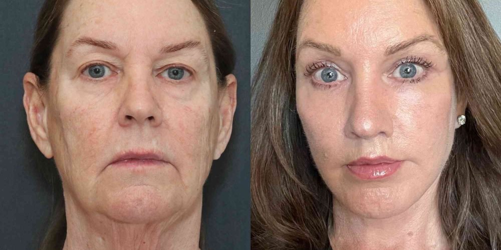 plastic-surgery-5-032625-a87427396c0046a29287c118c2d0b15c